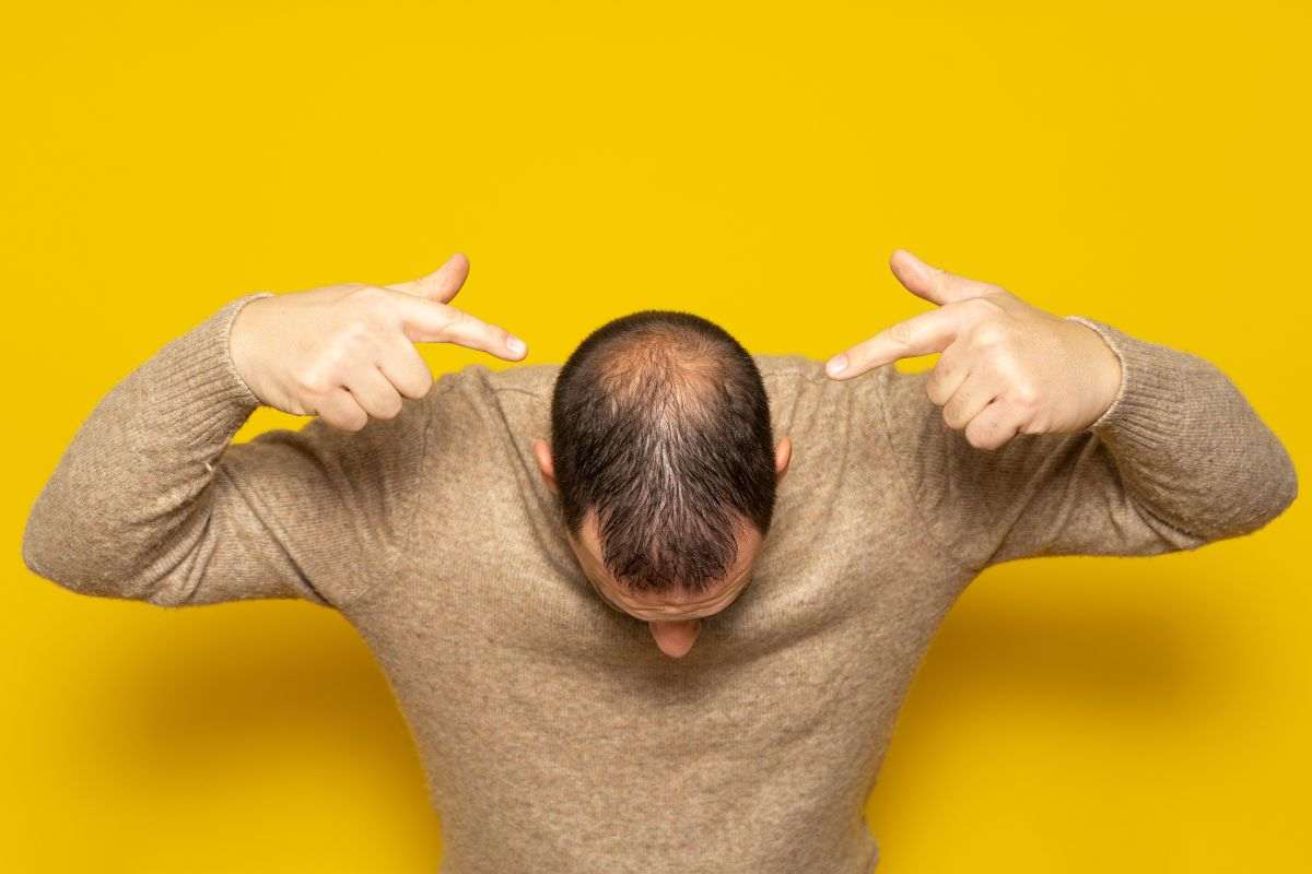 alopecia da stress