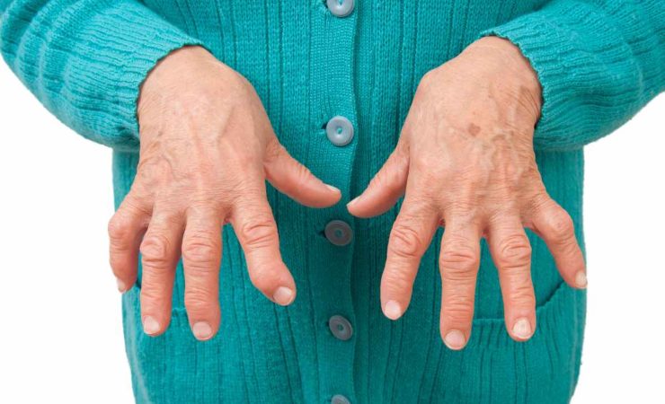 Artrite reumatoide sintomi
