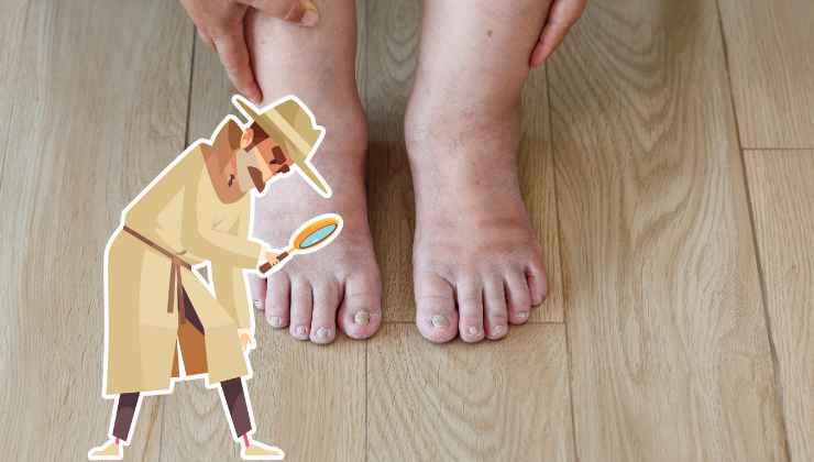 Prestare attenzione alla salute delle proprie dita dei piedi è il primo passo per riconoscere malattie più gravi