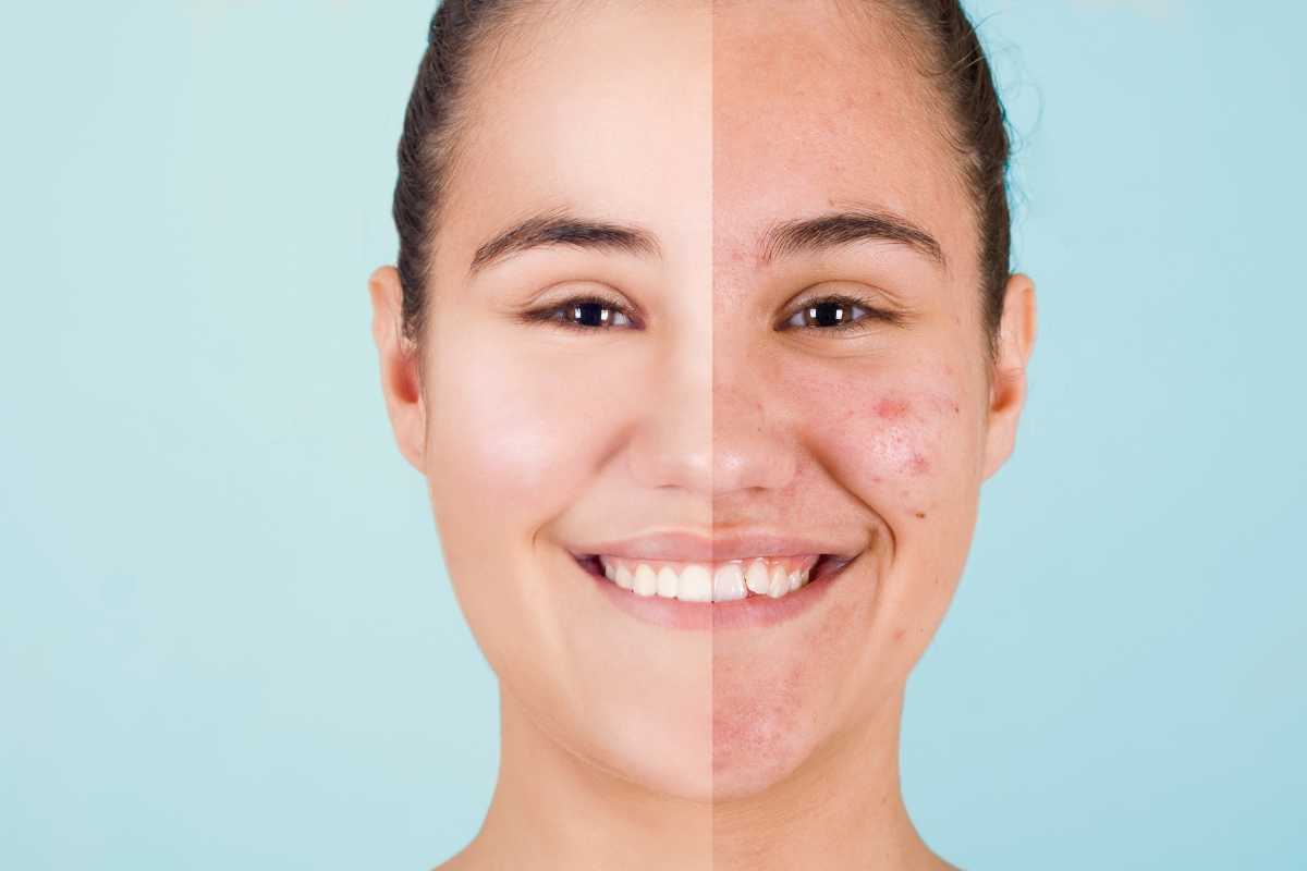 Come eliminare l'acne