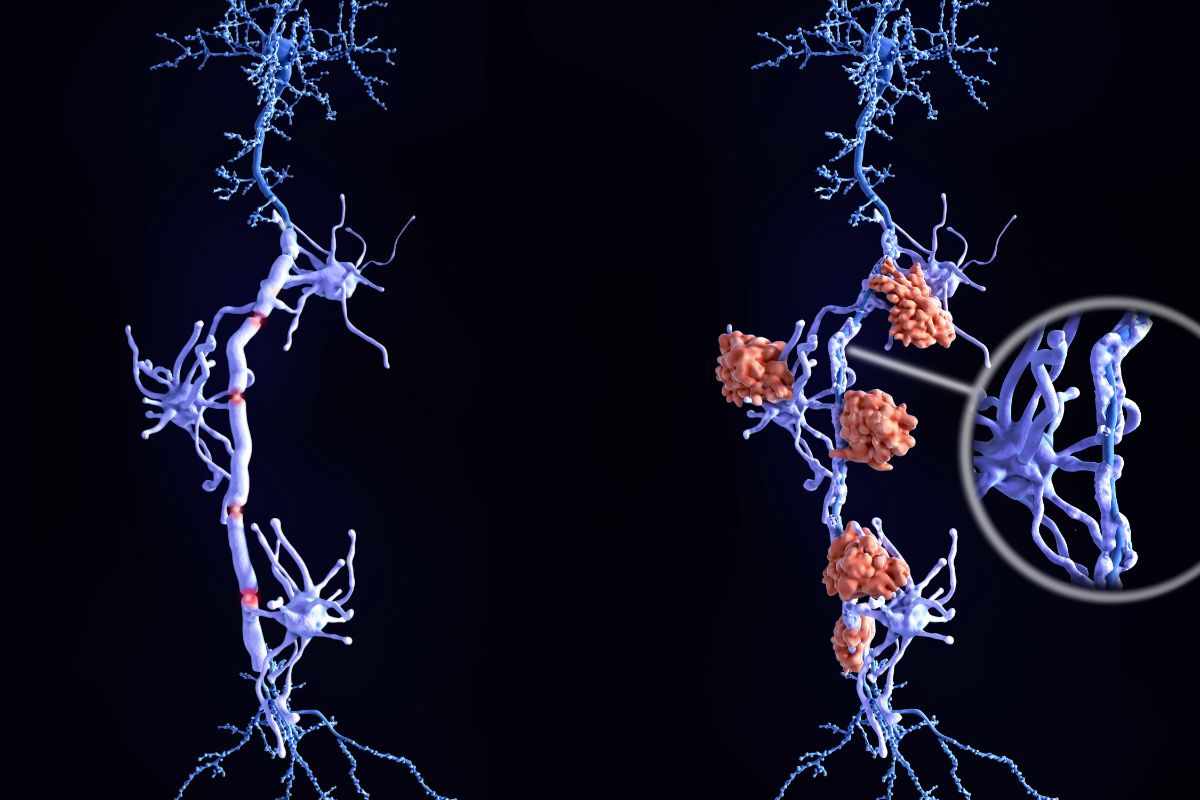 Conoscere i sintomi della sclerosi multipla allunga la vita
